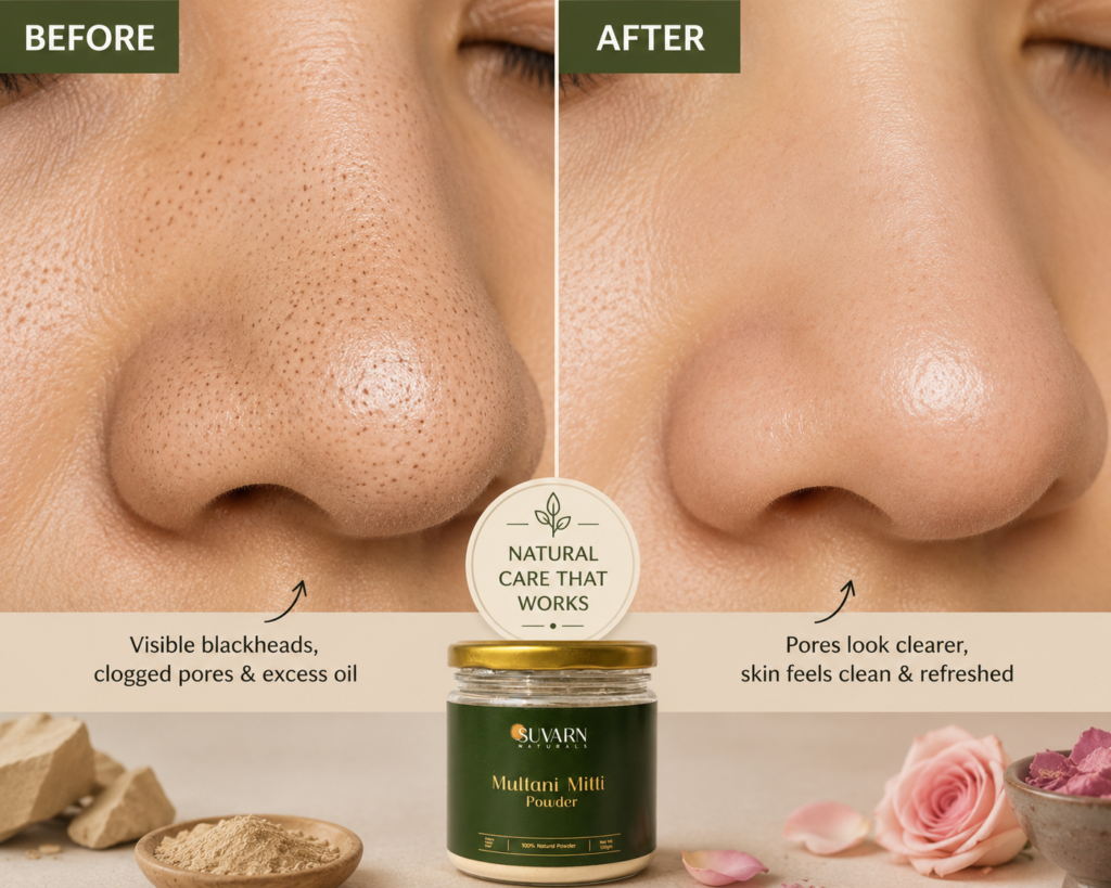 Visible improvement in blackheads after consistent Ayurvedic routine