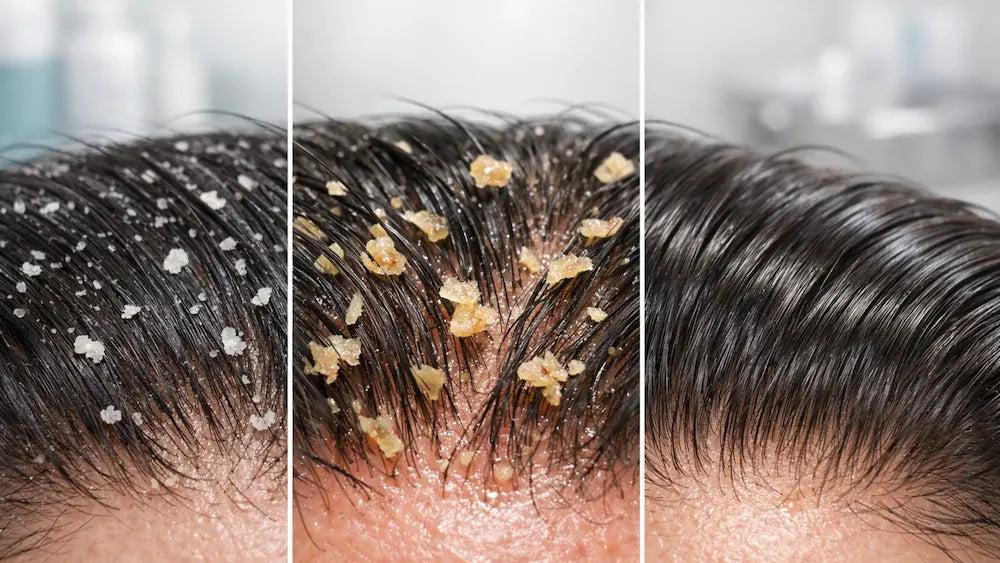 Dandruff vs Dry Scalp
